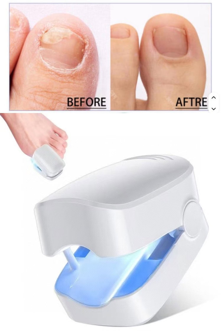 RapidClear Nail Fungus Laser Device: Eliminate Stubborn Onychomycosis Fast