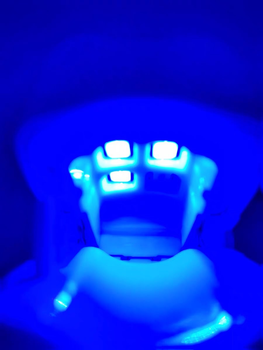 BrightNail Pro Digital Display Nail Fungus Cleaning Laser Device – Erase Fungal Nails Effortlessly - Image 4