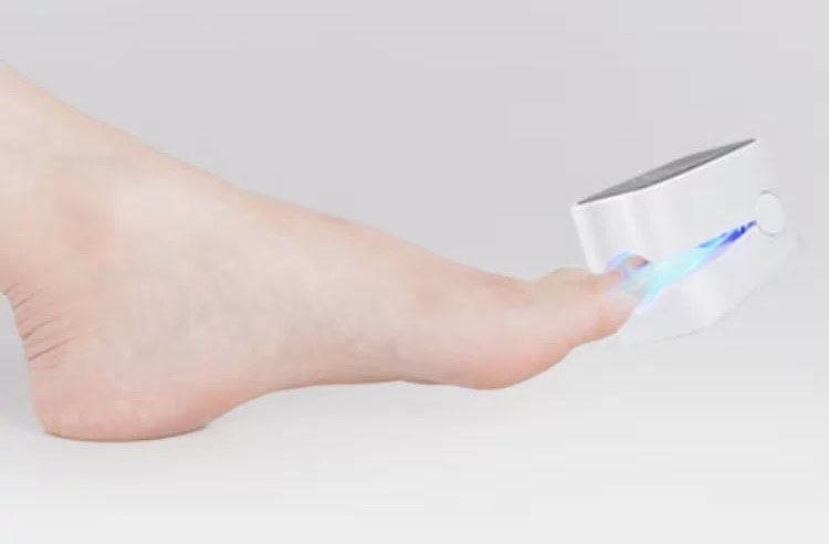 BrightNail Pro Digital Display Nail Fungus Cleaning Laser Device – Erase Fungal Nails Effortlessly - Image 7