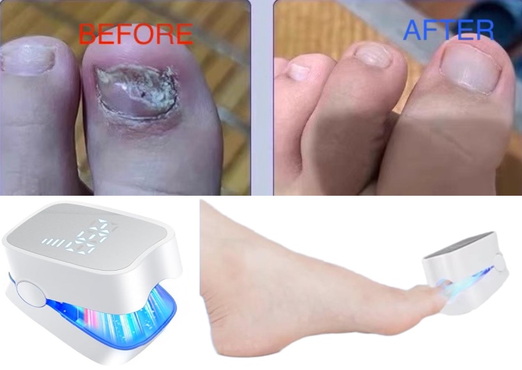 BrightNail Pro Digital Display Nail Fungus Cleaning Laser Device – Erase Fungal Nails Effortlessly